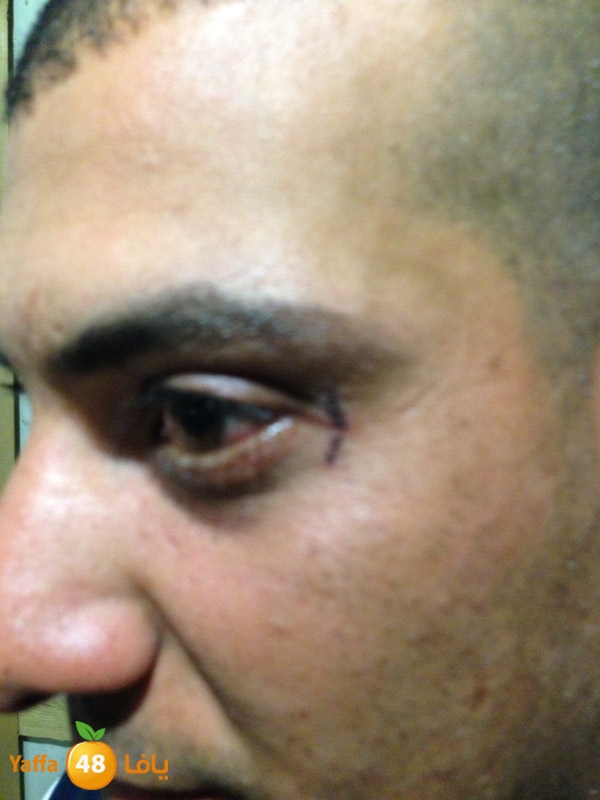 phoneludinjury (13).JPG